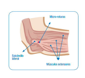 Epicondilitis lateral