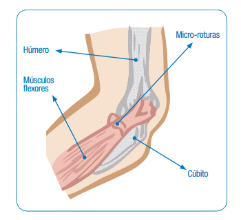 Epicondilitis medial o epitrocleitis