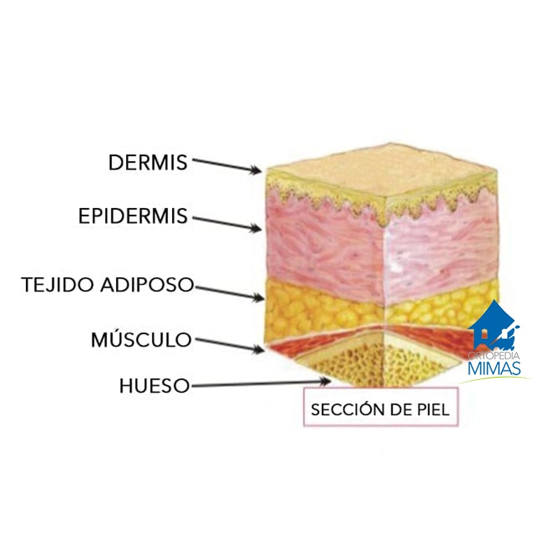 Tipos de Escaras